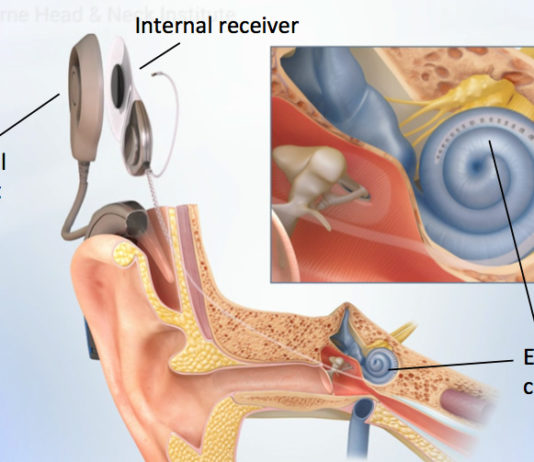 Know About The Success-Rate of Cochlear Implant in India Cochlear Implant Surgery Cost