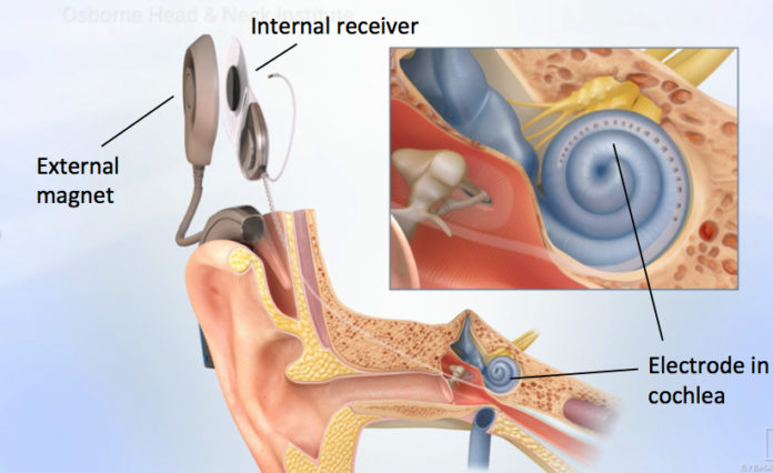 Cochlear Implant Surgery Cost