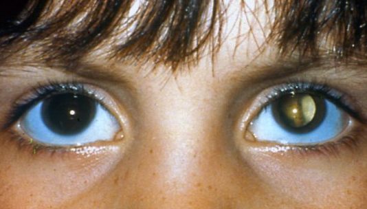 10 Signs that your Child has Vision Problems