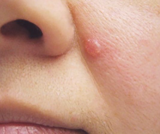 What is Skin Sell and Skin Mole or Tag, effected for Skin cancer?