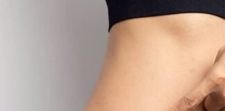 5 Useful Tips to Prevent and Treat Stretch Marks