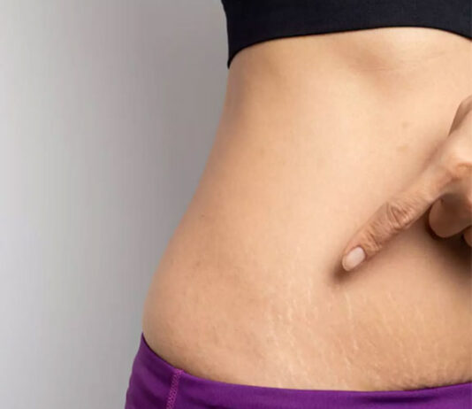 5 Useful Tips to Prevent and Treat Stretch Marks