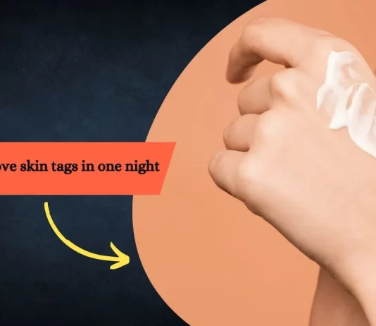 How to remove skin tags in one night – with Home Remedies how to remove skin tags in one night